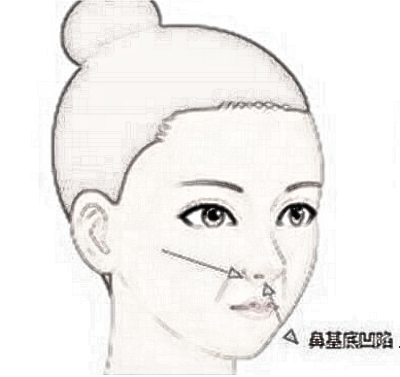 隆鼻术真能改良凸嘴吗?