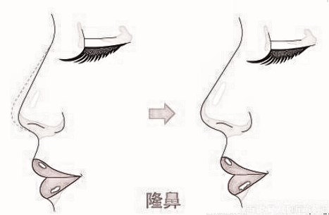 假体隆鼻之所以出现变形是这样的！