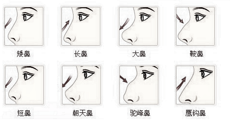 耳软骨隆鼻适用于那些人群?