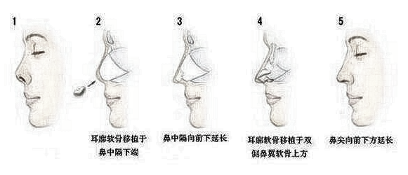 耳软骨隆鼻适用于那些人群？