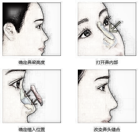 耳软骨隆鼻适用于那些人群？