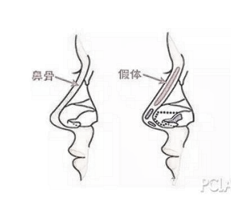 西安做假体隆鼻怎么样呢？假体隆鼻有几种方式？