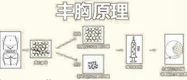 自体脂肪隆胸的方式及过程!