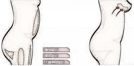 自体脂肪隆胸的方式及过程!