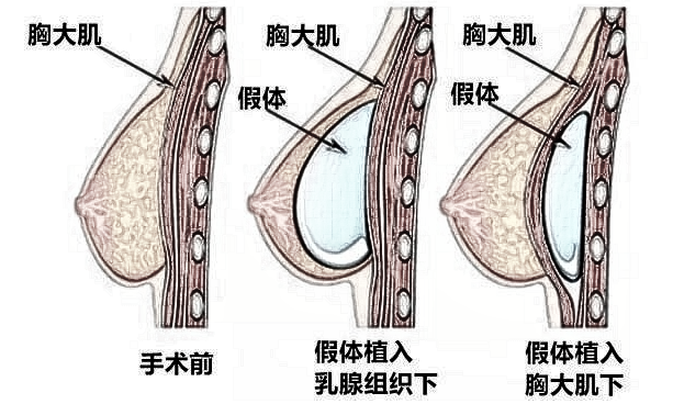 假体隆胸怎么样？可靠吗？果如何？
