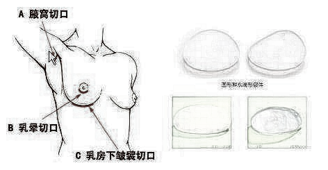 假体隆胸没问题吗?术后果怎么样?