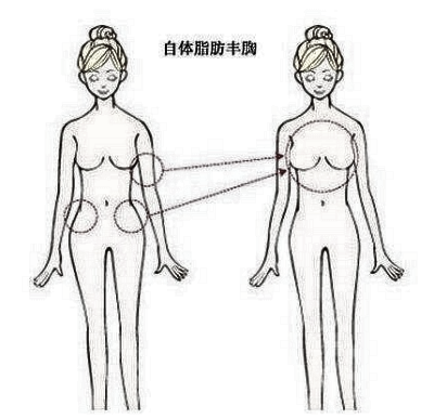 隆胸有何优势？自脂隆胸和假体隆胸哪个更好？