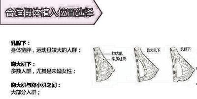 隆胸有何优势？自脂隆胸和假体隆胸哪个更好？