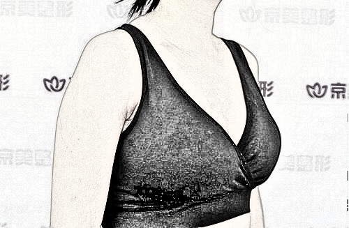 假体隆胸失败后,还能做自体脂肪丰胸吗?