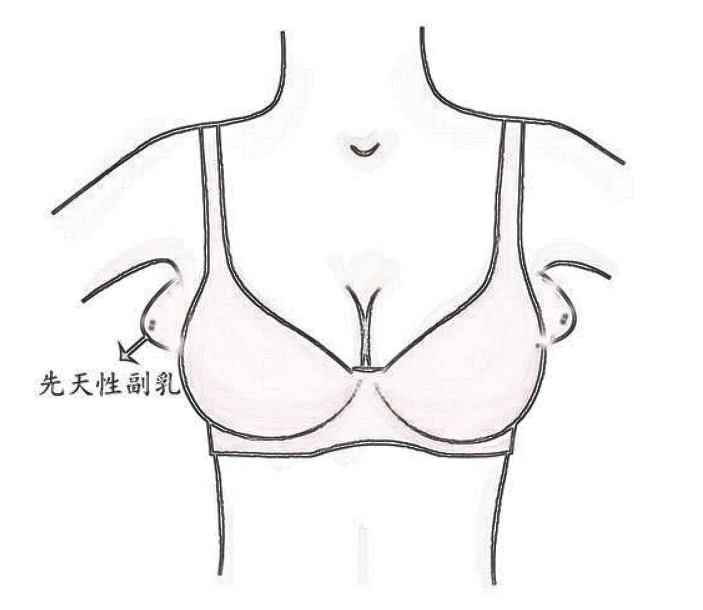 副乳分成这几类,你都知道吗?