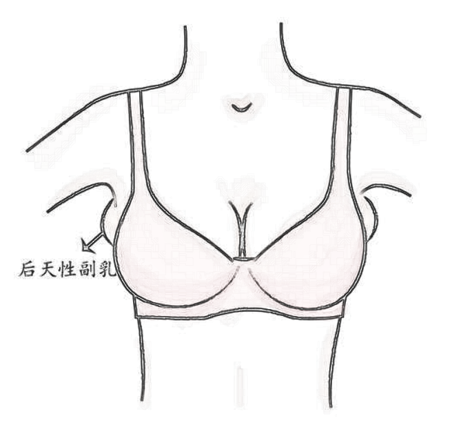副乳分成这几类,你都知道吗?