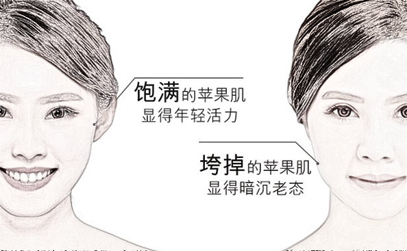 填充苹果肌之后多久才能消除肿胀?