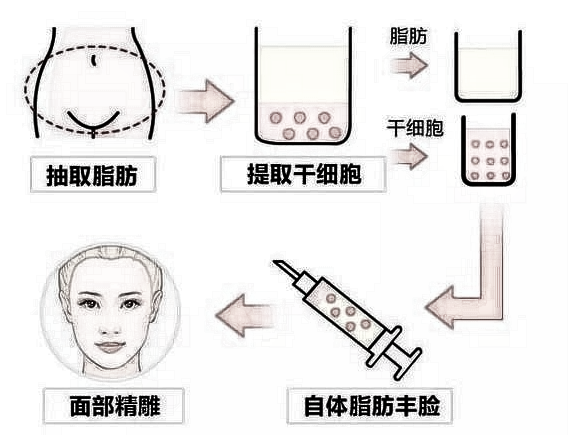 自体脂肪填充失败了还能修复吗?