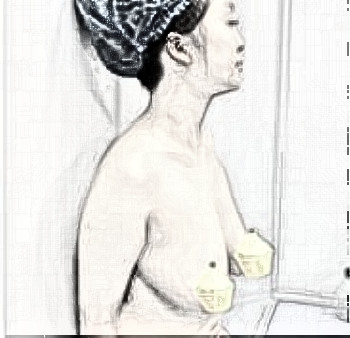 深圳爱美者假体隆胸术后90天果分享!看下果如何?
