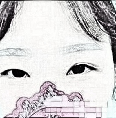 北京尹林丽格医疗美容切开双眼皮术后感受分享！