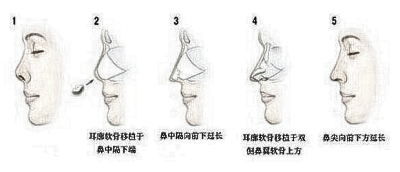 鼻尖整形手术的植入物材料有什么区别？