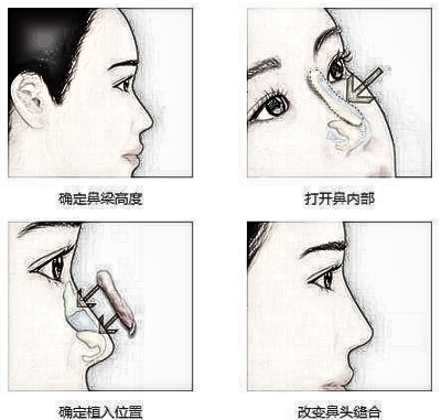 做自体耳软骨隆鼻多少钱？7800可以做吗？