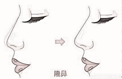 做自体耳软骨隆鼻多少钱？7800可以做吗？