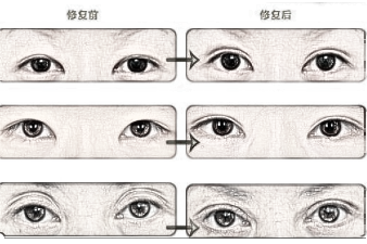 双眼皮修复术前注意你都知道吗？