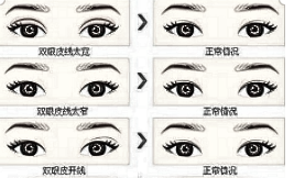 双眼皮修复术前注意你都知道吗？