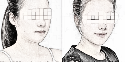 【玻尿酸】透明质酸适用于圆脸的姐妹隆鼻吗？