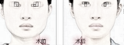 想要瘦脸都有哪些医美手术方法？