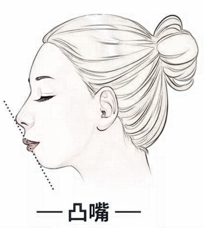 哪些原因会导致下巴回缩?