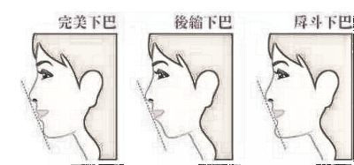 哪些原因会导致下巴回缩?