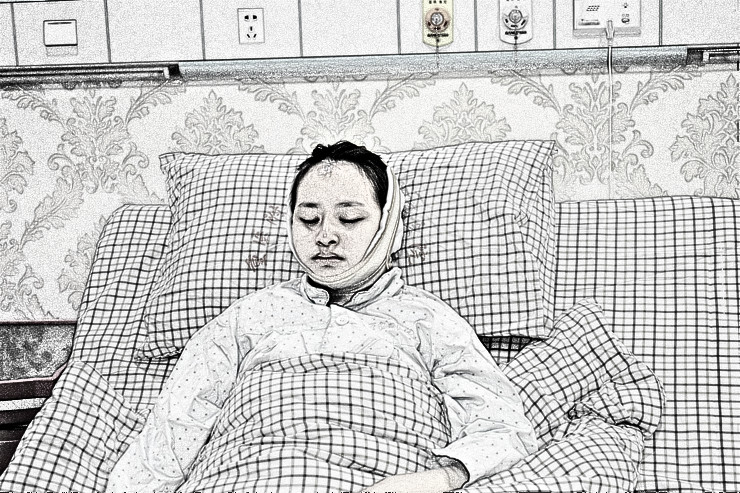 重庆小姐姐下颌角整形术后果分享!