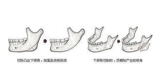 下颌角整形术前事项你知道吗?