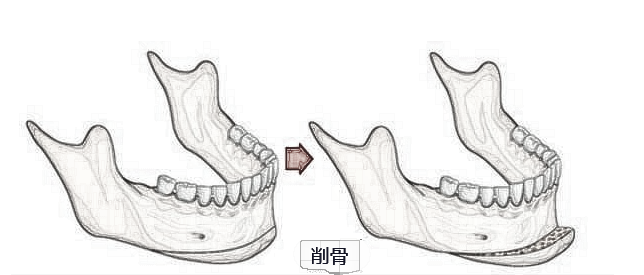 下颌角或者医美美容削骨后的后遗症是什么？如何避免？