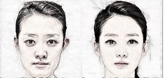 上海整形医生建议我做下颌角手术,有必要吗?
