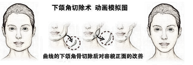 上海整形医生建议我做下颌角手术,有必要吗?
