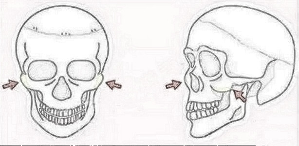 在北京做颧骨内推手术失败后，还能恢复吗？