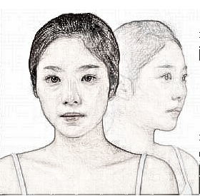在北京做颧骨内推手术失败后，还能恢复吗？