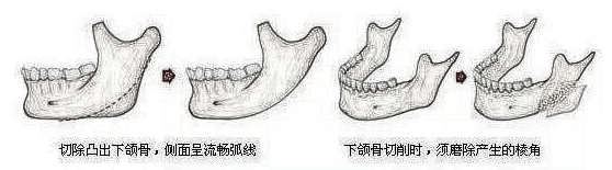 内行人怎么看待北京张笑天的下颌角手术？