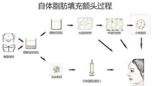 丰额头有哪三种方法比较好呢?