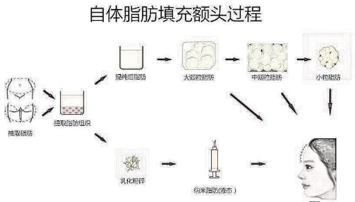 丰额头有哪三种方法比较好呢？