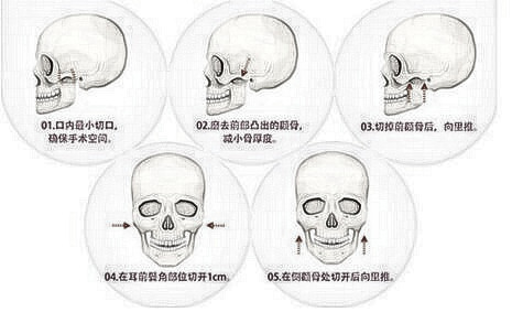 颧骨整形手术价格是不是真的不值那么多钱