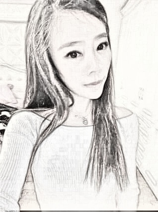术后3个月 下颌角手术介绍 面部填充手术果分享