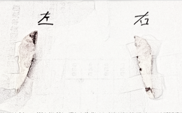 浙江小姐姐磨骨手术介绍分享!