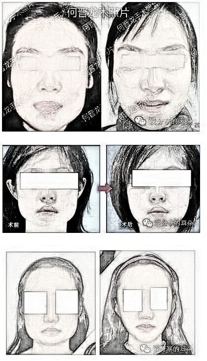 上海时光何晋龙下颌角磨骨怎么样?多少钱?