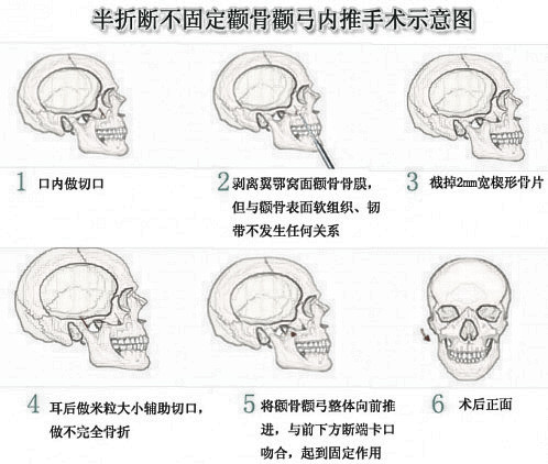 俞良钢做颧骨整形怎么样?