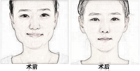 下颌角宽大想要瓜子脸、鹅蛋脸怎么办？有什么