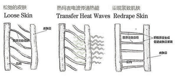 面部松弛有细纹该做热拉提还是“热麻吉”？