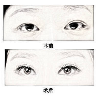 在做定点双眼皮之前较先应该考虑什么？当然是价格