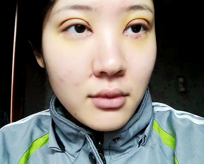 上海这家医院做的双眼皮，真的爱了！！！