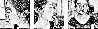 重庆小姐姐膨体垫下巴术后70天分享附！