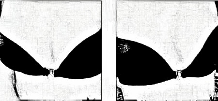 杭州华山连天美医美医生高俊明假体隆胸介绍分享！