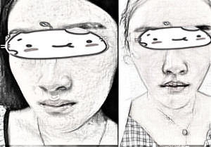 辽宁鞍山爱美者自体脂肪面部填充术后感受分享！